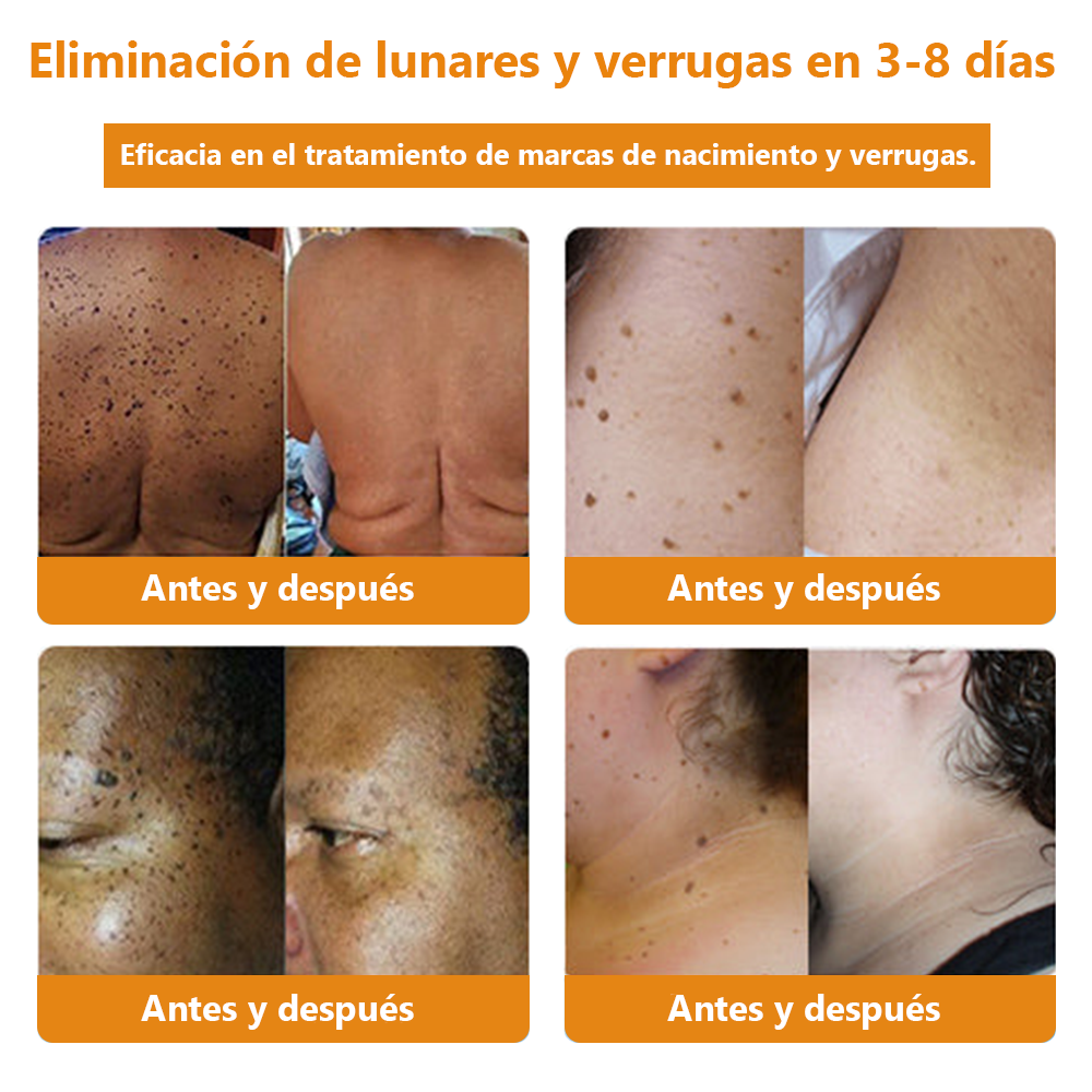 Lenaro™ Crema para el tratamiento de verrugas con veneno de abeja💎 (👨⚕️COFEPRIS RECOMMENDS)