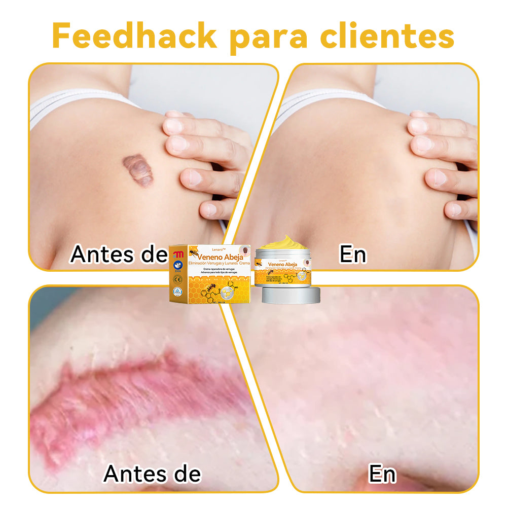 Lenaro™🏆🏆🏆 Veneno Abeja Eliminación Verrugas y Lunares Crema (🌞Último día de promoción 80% de descuento)