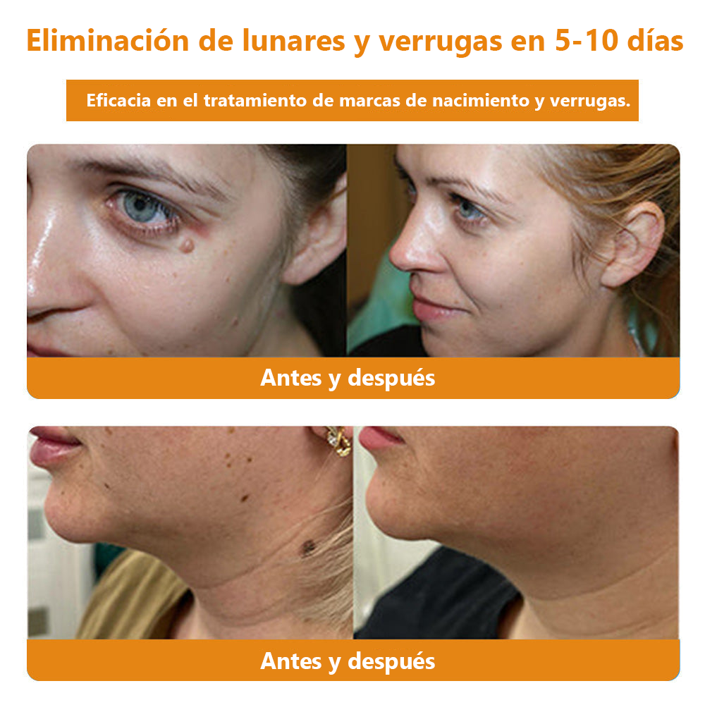 Lenaro™ Crema para el tratamiento de verrugas con veneno de abeja💎 (👨⚕️COFEPRIS RECOMMENDS)