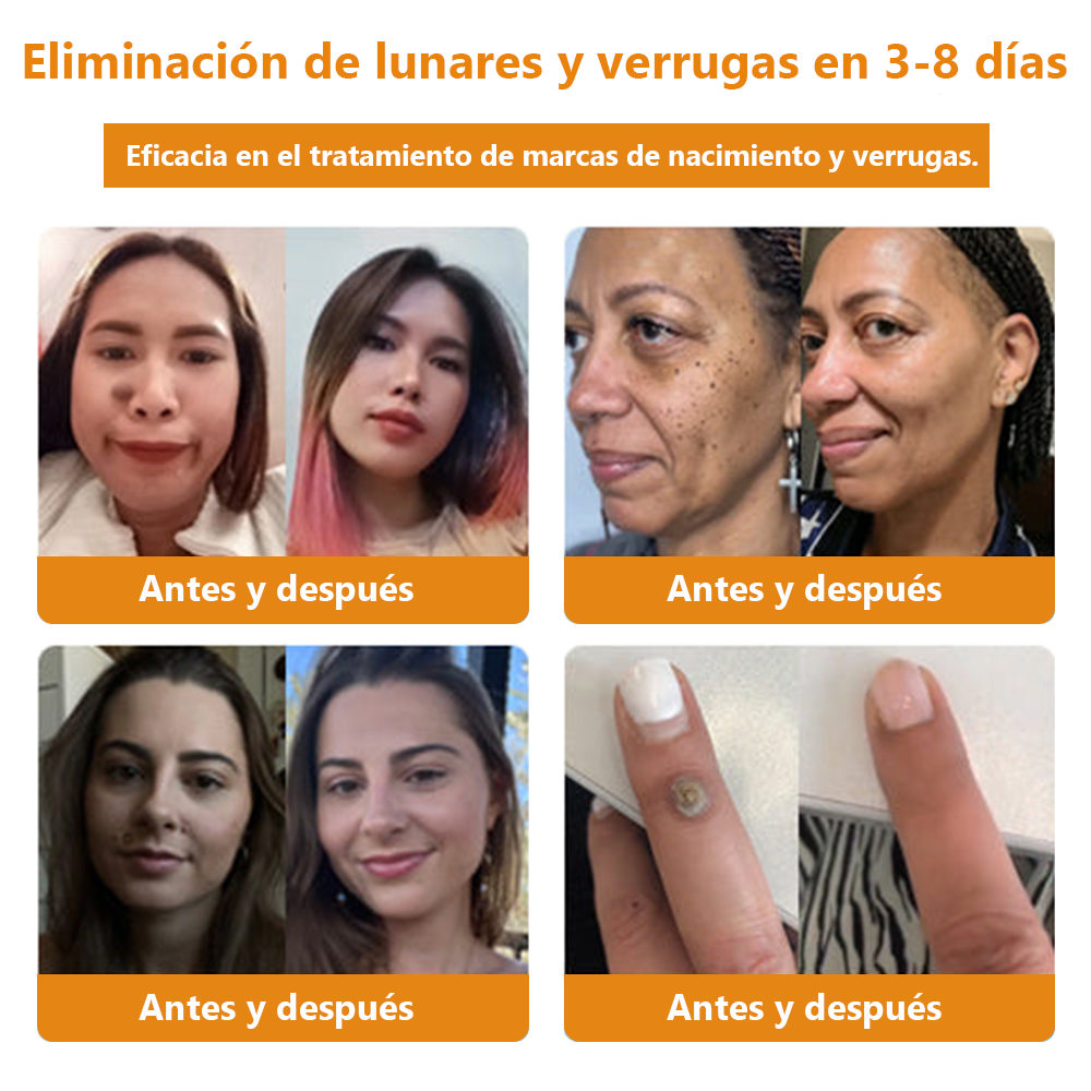 Lenaro™ Crema para el tratamiento de verrugas con veneno de abeja💎 (👨⚕️COFEPRIS RECOMMENDS)