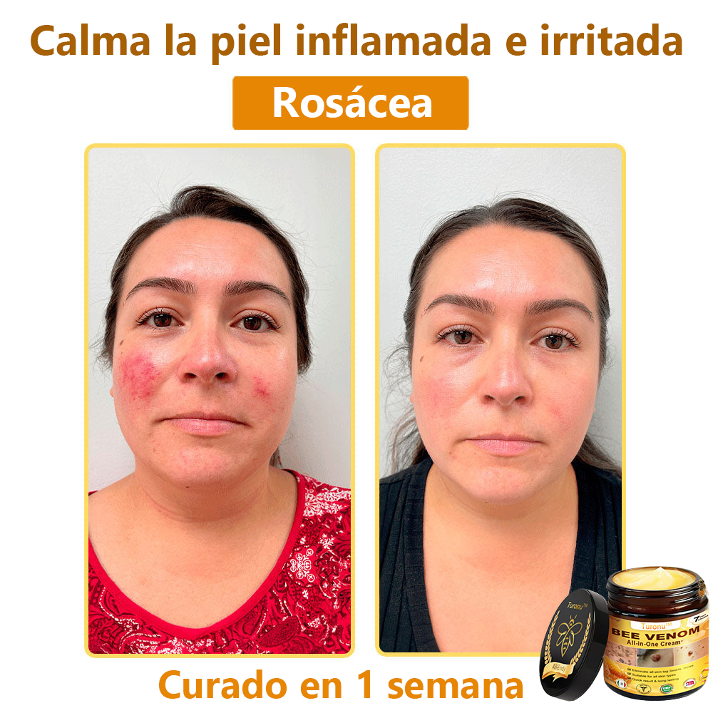Turonu™ Bee Venom All-in-One Cream🎁Tiempo limitado 80% de descuento⏱️