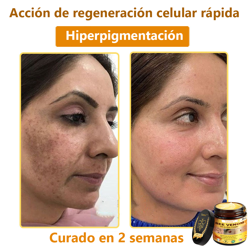 Turonu™ Bee Venom All-in-One Cream🎁Tiempo limitado 80% de descuento⏱️