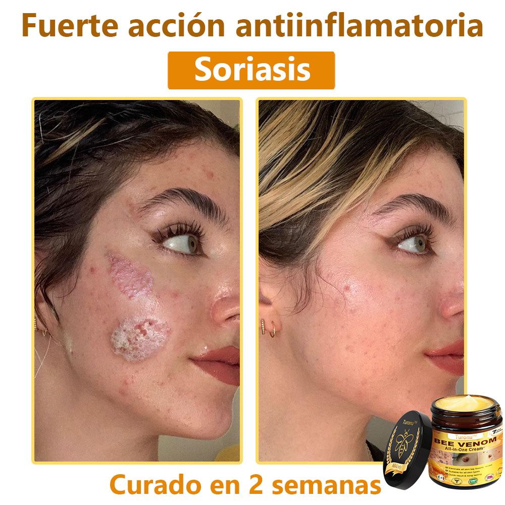 Turonu™ Bee Venom All-in-One Cream🎁Tiempo limitado 80% de descuento⏱️