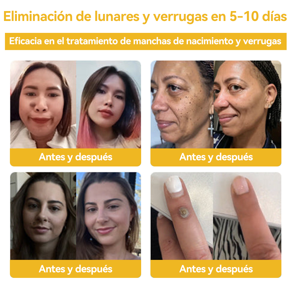 Vsóxa™ Veneno Abeja Eliminación Verrugas y Lunares Crema👑(Último día de promoción 80% de descuento)