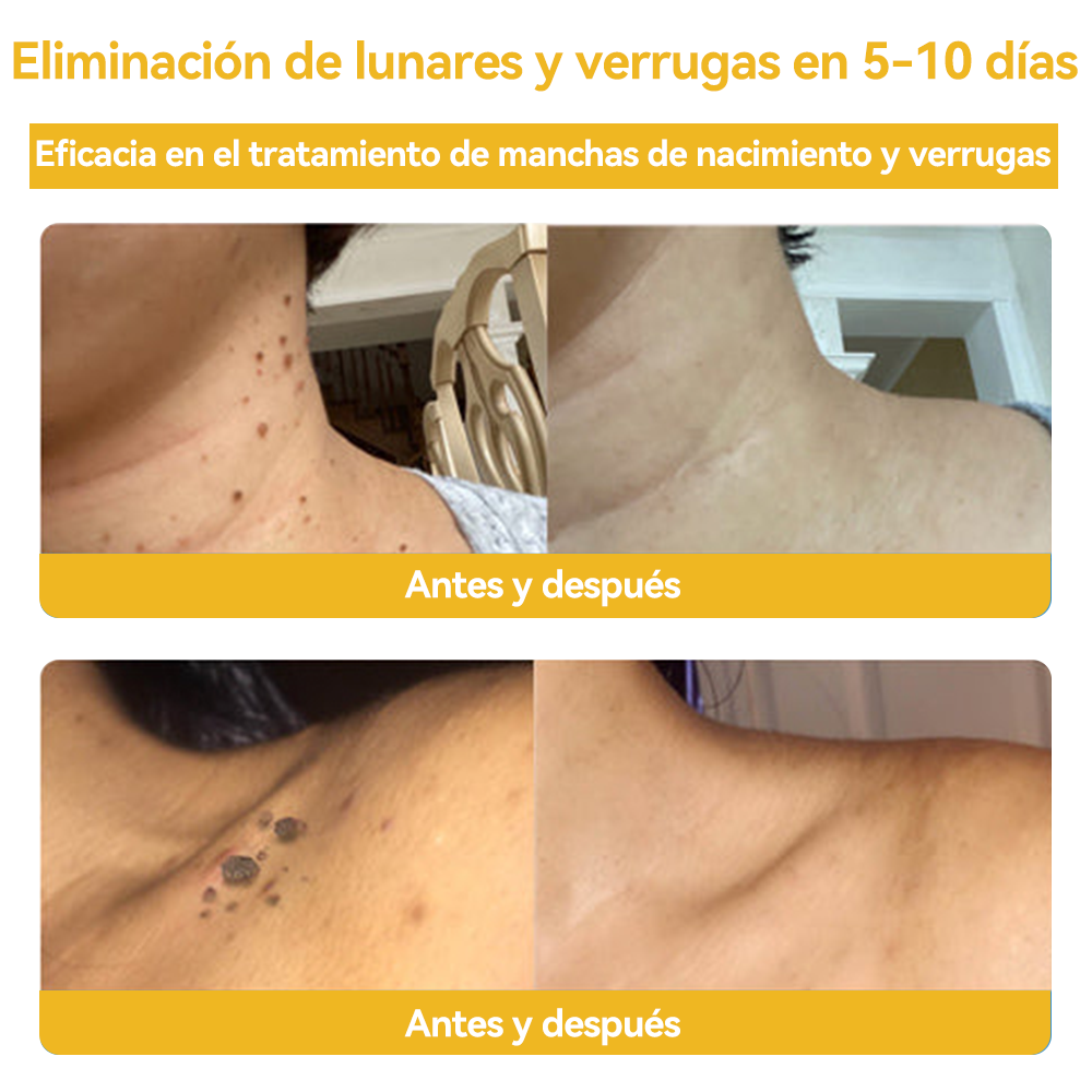 Vsóxa™ Veneno Abeja Eliminación Verrugas y Lunares Crema👑(Último día de promoción 80% de descuento)