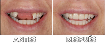 Sitio web oficial: Bikenda™ Kit para prótesis dentales de silicona🏅Recomendado por la Asociación Dental Mexicana🎁